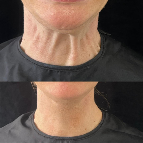 Resultado antes e depois 4