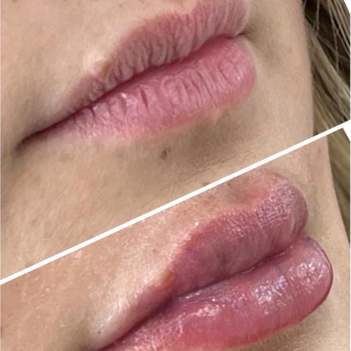 Resultado antes e depois 5