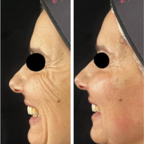 Resultado antes e depois 3