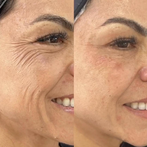 Resultado antes e depois 4