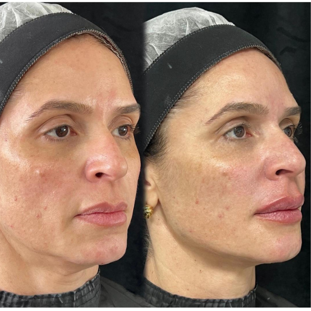 Resultado antes e depois 1