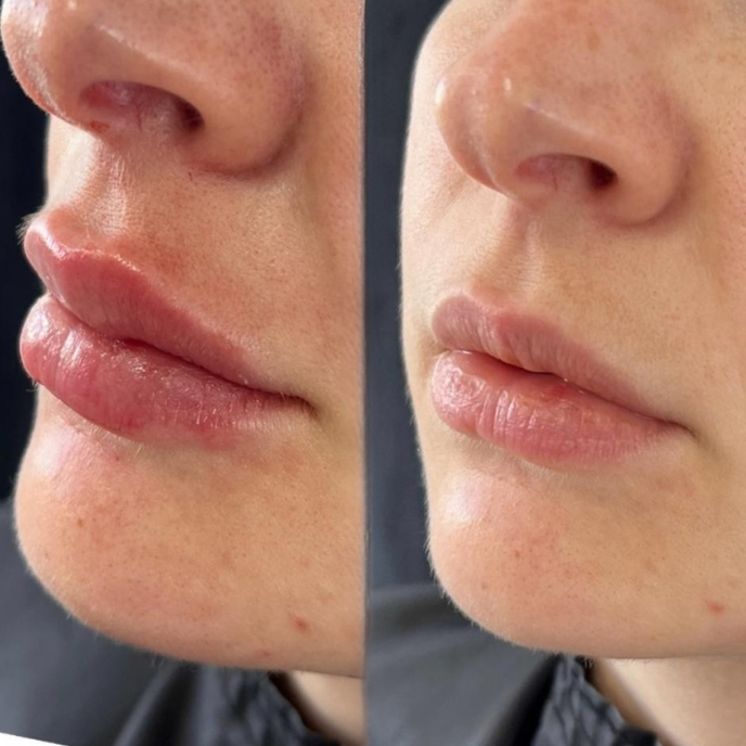 Resultado antes e depois 3